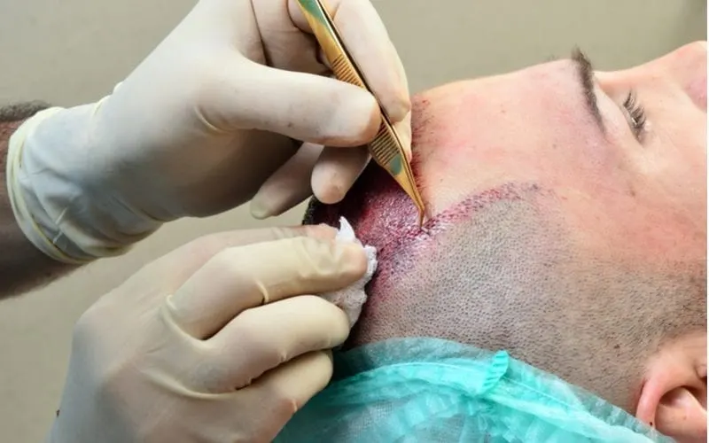 Guy getting a hair graft from a doctor and looking straight up for a piece on hair transplant cost