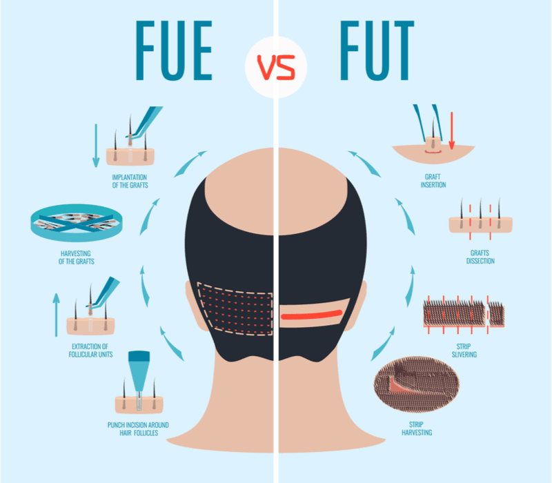 Fue vs Fut hair transplant cost graphic