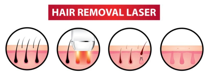 Laser Hair Removal Cost | High, Low, & Average Prices