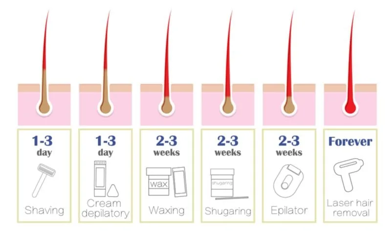 Laser hair removal timeline vs other hair removal methods