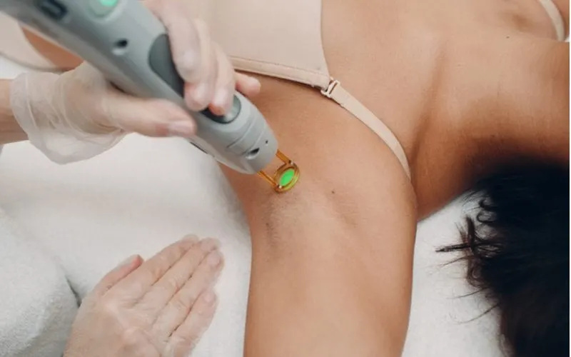For a piece on how much does laser hair removal cost, a woman getting treatment under her arm