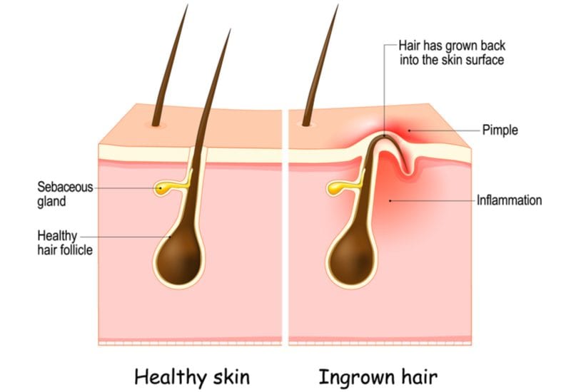 Image of an ingrown hair illustrated in a side by side of that and a healthy follicle for a piece on what is an ingrown hair