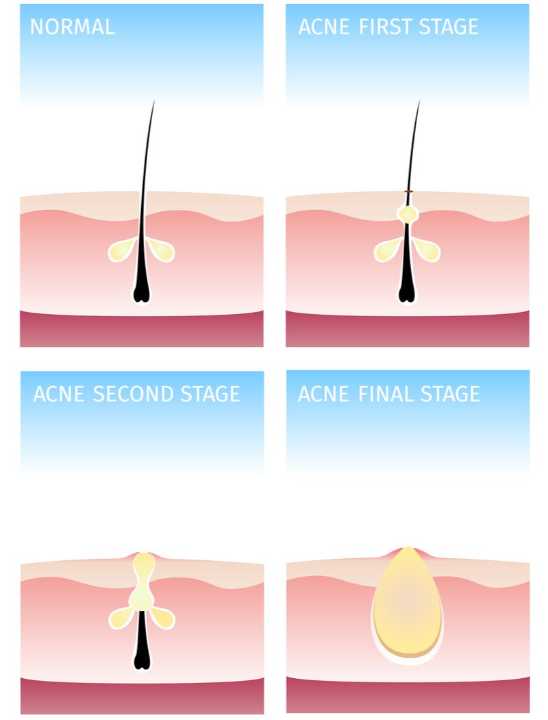 Image showing how acne happens for a piece on how to clarify your hair