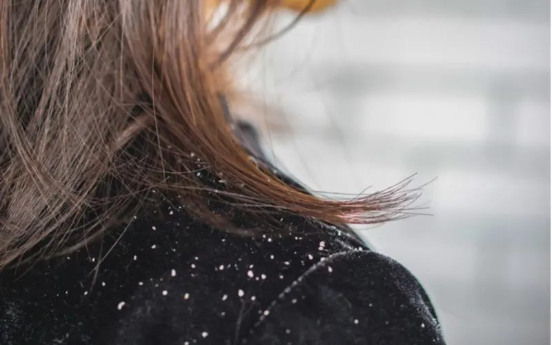 For a piece on how to get rid of dandruff, a woman with lots of skin flakes on her shoulder in a black shirt