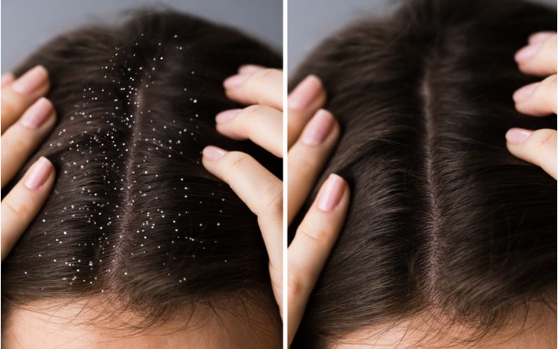 Hình ảnh một người phụ nữ ôm da đầu của mình trong hình ảnh cạnh nhau để tìm hiểu về cách loại bỏ gàu