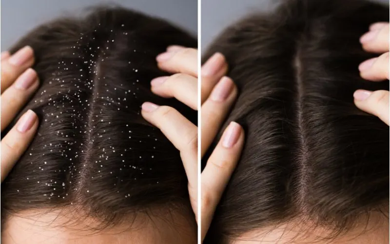 Image of a woman holding her scalp in a side-by-side image for a piece on how to get rid of dandruff