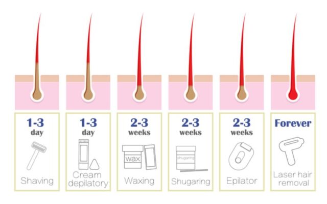 How Often Do You Get Laser Hair Removal