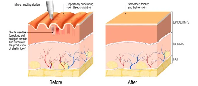Microneedling for hair loss graphic