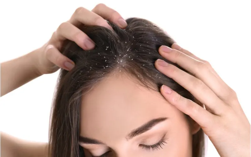 Woman that needs to learn how to get rid of dandruff without shampoo because her scalp is flaking