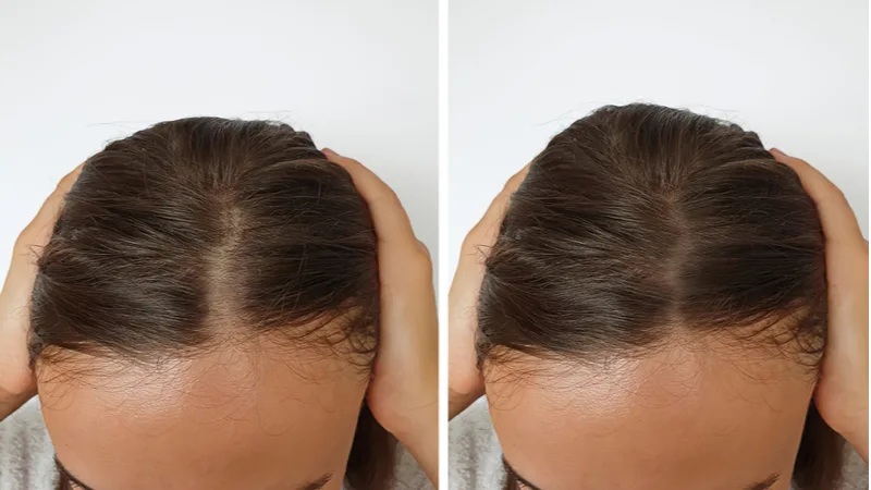 Before and after of a woman who took a hair loss supplement