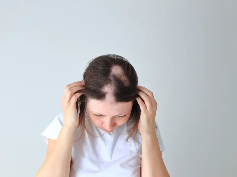 Woman with alopecia wondering, "Why Is My Hair Falling Out?"
