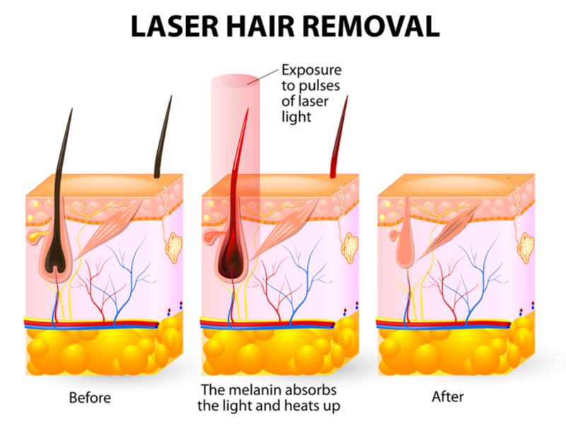 How laser hair removal works for a piece on should you get laser hair removal