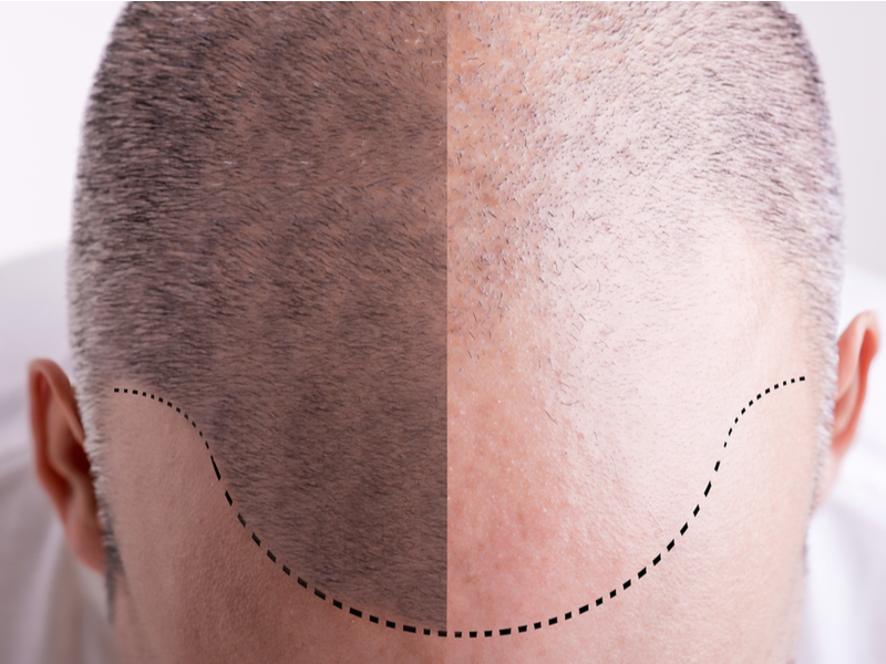 Image showing whether you should get a hair transplant