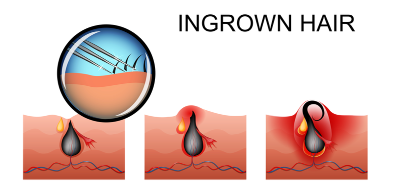 Image showing what an ingrown hair is for a guide on how to remove them