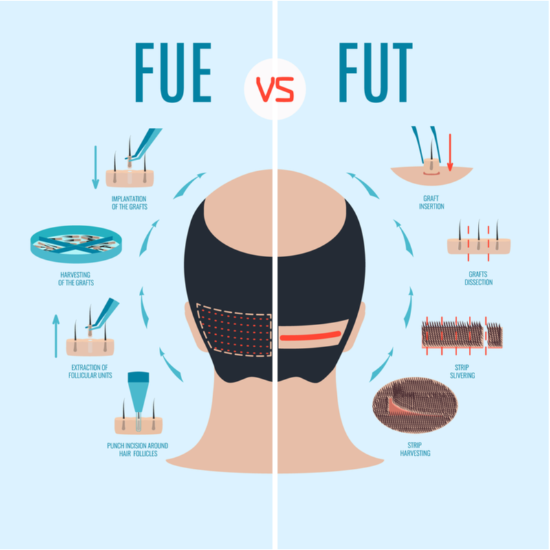 Cấy ghép Fue vs Fut cho một mảnh có tiêu đề Tôi có nên cấy ghép tóc