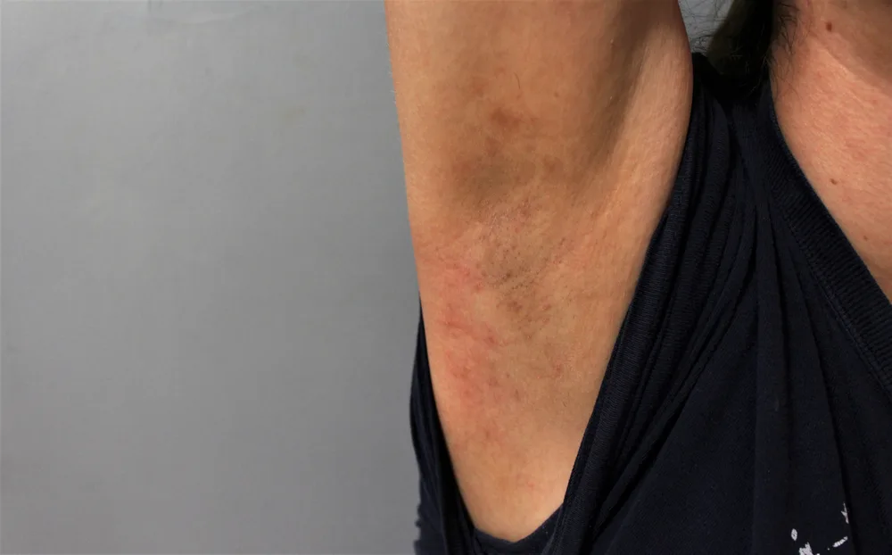 Woman with a rash under her arm with red skin all around because she didn't use the right shaving cream substitute