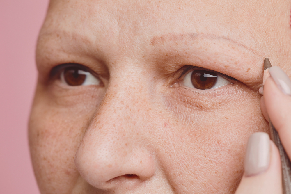 Woman with alopecia (hair loss) on her eyebrows for a piece on do eyebrows grow back
