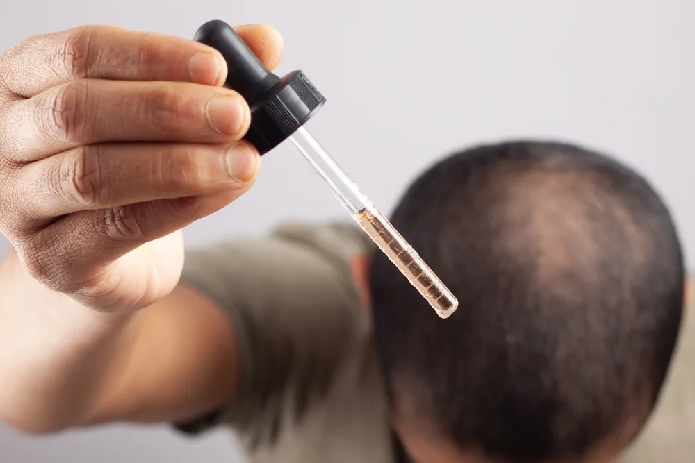 Guy applying an alternative to Minoxidil to his head with a hair oil dropper