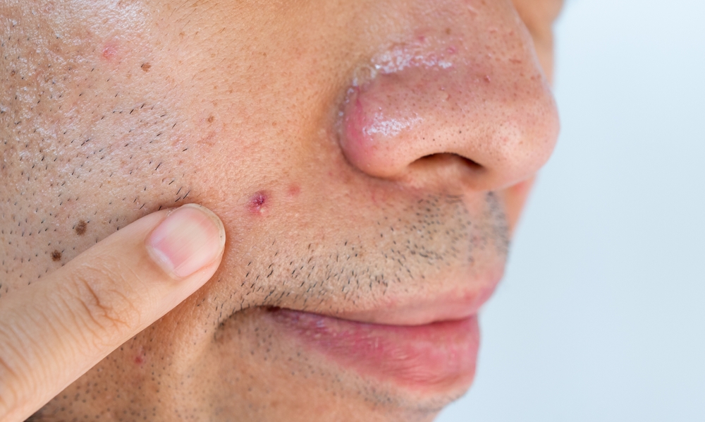 Image of a person pointing to a pimple on his face for a piece on does beard oil help hair growth