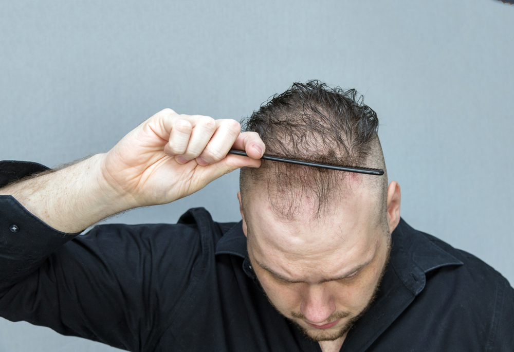 Man with thin hair pulls back his hair with a comb