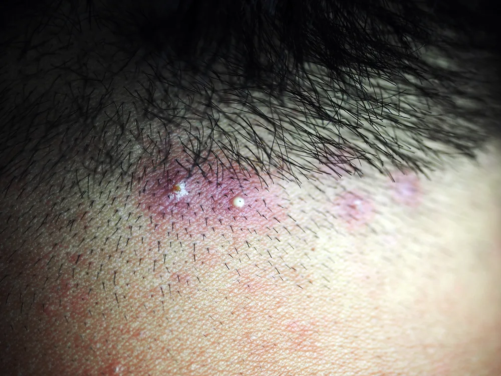 Man with folliculitis who needs the best shampoo for this ailment as seen in a close-up image