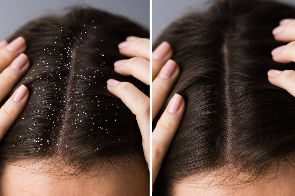 Before and after photo depicting how scalp might look after using glycolic acid for dandruff and flakes on dark hair