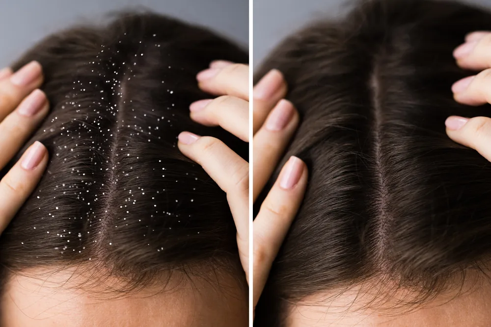 صورة قبل وبعد توضح كيف تبدو فروة الرأس بعد استخدام حمض الجليكوليك لعلاج القشرة والقشور على الشعر الداكن