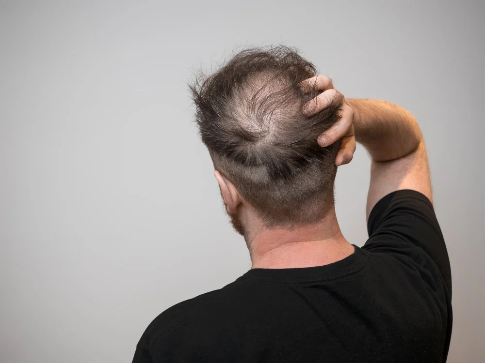 Man with a bald spot holding his head and wondering about the best hair products for thin haired males