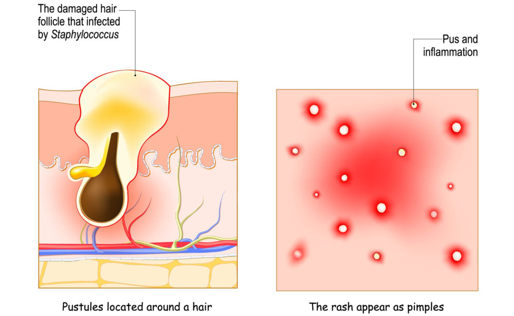 Image of what folliculitis is and why you need a shampoo for it