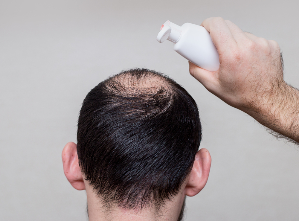 Guy using one of the best products for males with thin hair and holding the bottle to his bald spot