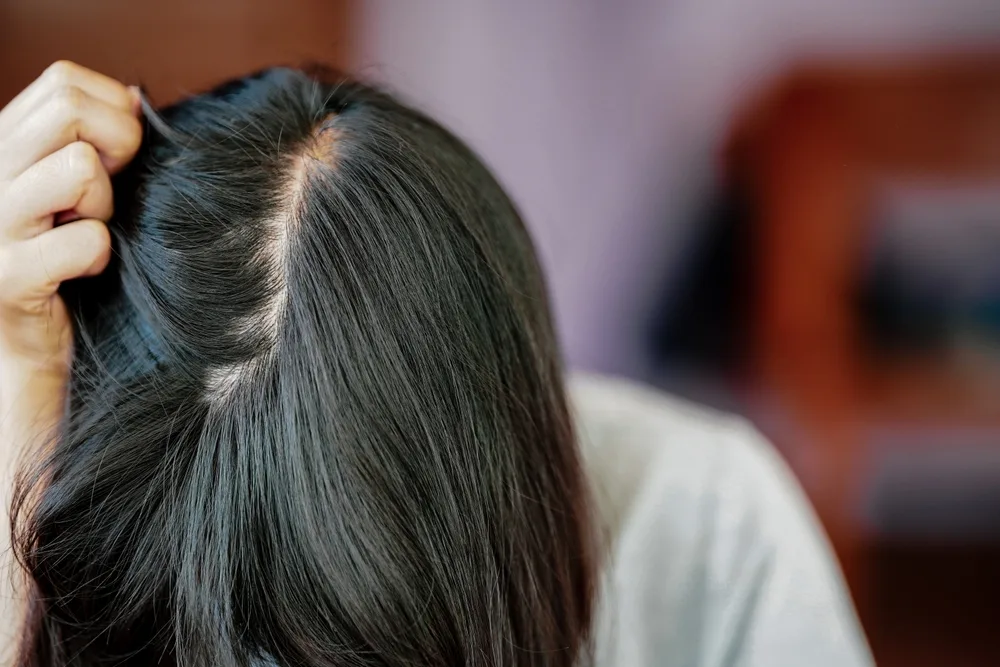 Woman looking down with head resting on her hands, showing hair loss and thinning on crown that can be remedied with the right hairstyles